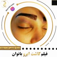 کاشت ابرو متقارن | کلینیک پایتخت | 44228594-021