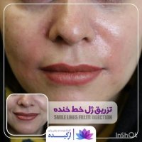 تزریق ژل خط خنده در کلینیک ارکیده