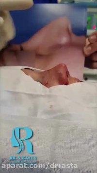 فیلم جراحی بینی استخوانی