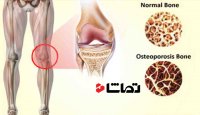 کشف سرنخ های جدید برای درمان پوکی استخوان