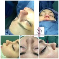 جراحی بینی ترمیمی با استفاده از غضروف گوش