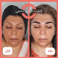 کاشت ابروی دائمی توسط دکتر فرشته جلالپور