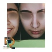 جراحی بینی استخوانی