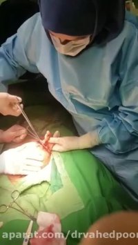 فیلم عمل جراحی توده تخمدان در خانم 60 ساله