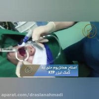 اصلاح همانژیوم حلق به کمک لیزر KTP
