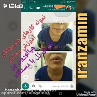 آموزش پلاسما جتآموزش هیالورون پن مجازی حضوری ایران زمین