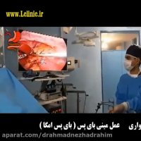 مینی بای پس ( امگا ) در خانم 49 ساله