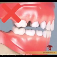 اهمیت نگهدارنده در رشد مرتب دندان های دائمی