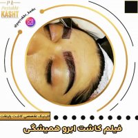 کاشت ابرو پرتراکم | کلینیک پایتخت | 44228594-021