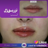 تزریق ژل لب در کلینیک ارکیده