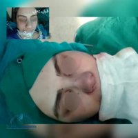 بینی بلافاصله بعد عمل