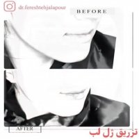 فیلم تزریق ژل لب