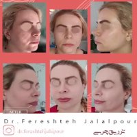 فیلم تزریق چربی دکتر فرشته جلال پور