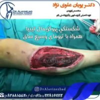 جراحی شکستگی پروگزیمال تیبیا