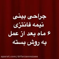 6 ماه بعد از عمل بینی