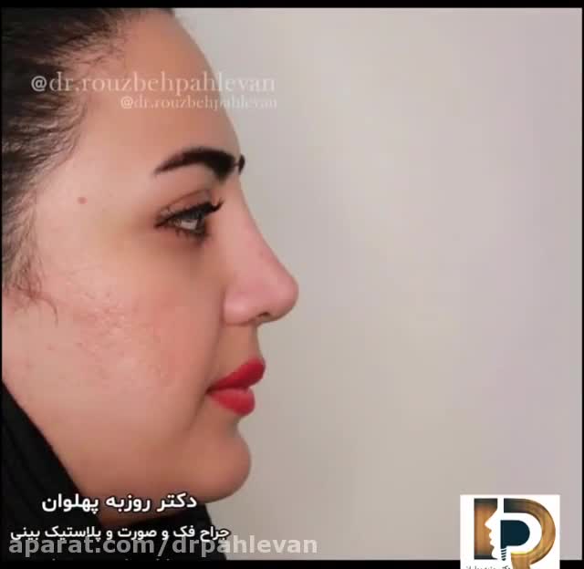 جراحی فانتزی بینی