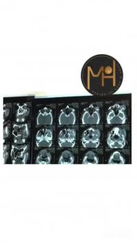 عود کردن تومور سینوس فکی