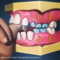 تاثیر مکیدن انگشت بر سلامت دهان و دندان کودک