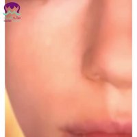 فیلم میکرونیدلینگ جوانسازی و ضد لک