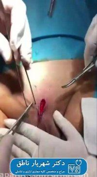 عمل زگیل تناسلی بزرگ توسط دکتر ناطق
