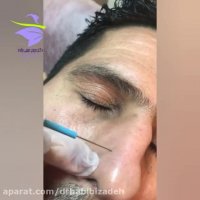 برداشتن خال سطحی از کنار بینی توسط دکتر حبیبی زاده