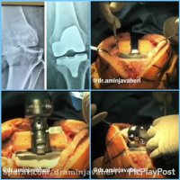 جراحی تعویض کامل مفصل زانو توسط دکتر علیرضا امین جواهری