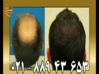 کاشت مو به روش SUT مرکز مو رنسانس