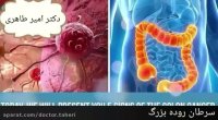 سرطان روده بزرگ | دکتر امیر طاهری