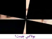 بوتاکس