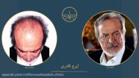 ایرج قادری قبل و بعد از کاشت مو در کلینیک دکتر نیلفروش زاده