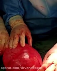 جراحی موفقیت آمیز کیست خوش خیم تخمدان