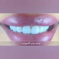 اصلاح طرح لبخند