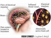 علائم بیماری میگرن و روش های سنتی و درمانی