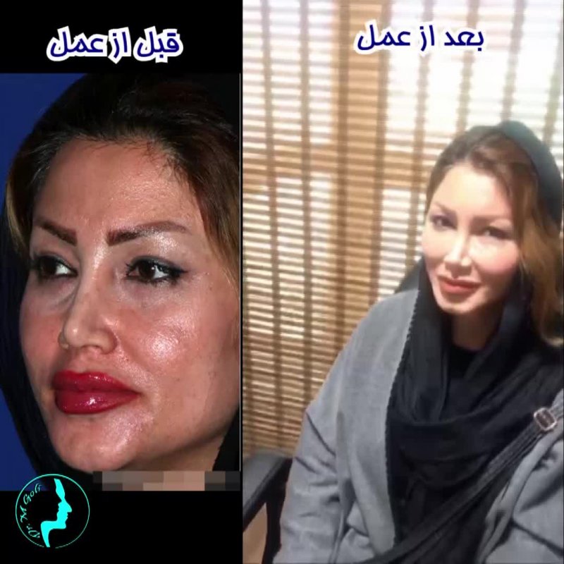 تزریق چربی و جوانسازی صورت | دکتر گلی