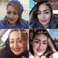 کاشت ابرو با تکنیک انحصاری کلینیک تخصصی رنسانس-02122088210