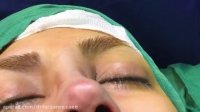 جراحی بینی به روش بسته