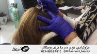 مزوتراپی موی سر چگونه است ؟