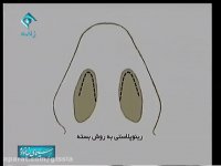 تفاوت جراحی بینی به روش باز و بسته