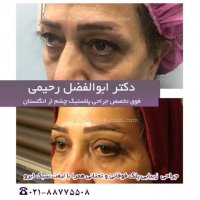 جوانسازی صورت با جراحی پلک