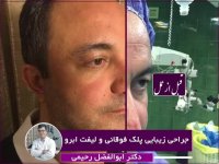 فیلم جراحی زیبایی پلک فوقانی و لیفت ابرو