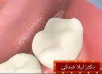 فیشور سیلنت