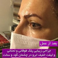 جراحی زیبایی پلک فوقانی و تحتانی