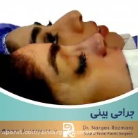 جراحی زیبایی بینی نیمه فانتزی به روش باز