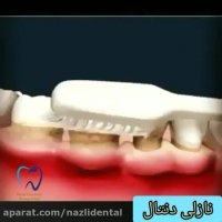 فیلم جرم گیری دندان