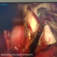 جراحی درمان کیست کلوئید و هیدروسفالی شدید