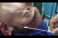 ترمیم اسکار صورت