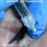 تزریق ژل زیر چشم