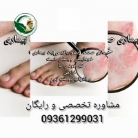 درمان قطعی بیماری اگزما !!! کافیه کلیپ رو ببینید