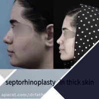 فیلم عمل بینی گوشتی با پوستی ضخیم