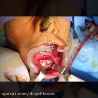 درمان شکستگی فک